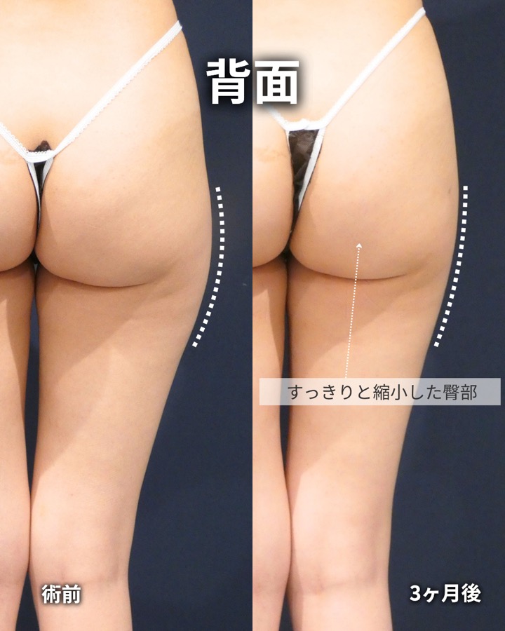 S.T styleクリニックの脂肪吸引（両太もも後側・両太もも外側・臀部） 症例写真 5/7