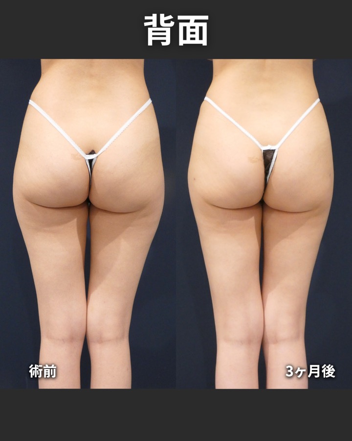 S.T styleクリニックの脂肪吸引（両太もも後側・両太もも外側・臀部） 症例写真 6/7