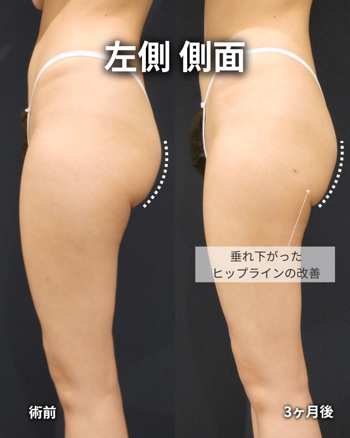 S.T styleクリニックの脂肪吸引（両太もも後側・両太もも外側・臀部） 症例写真 7/7