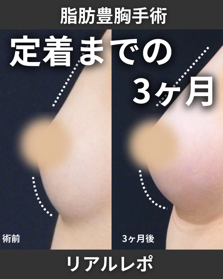 S.T styleクリニックのピュアグラフト豊胸術 症例写真 1/6