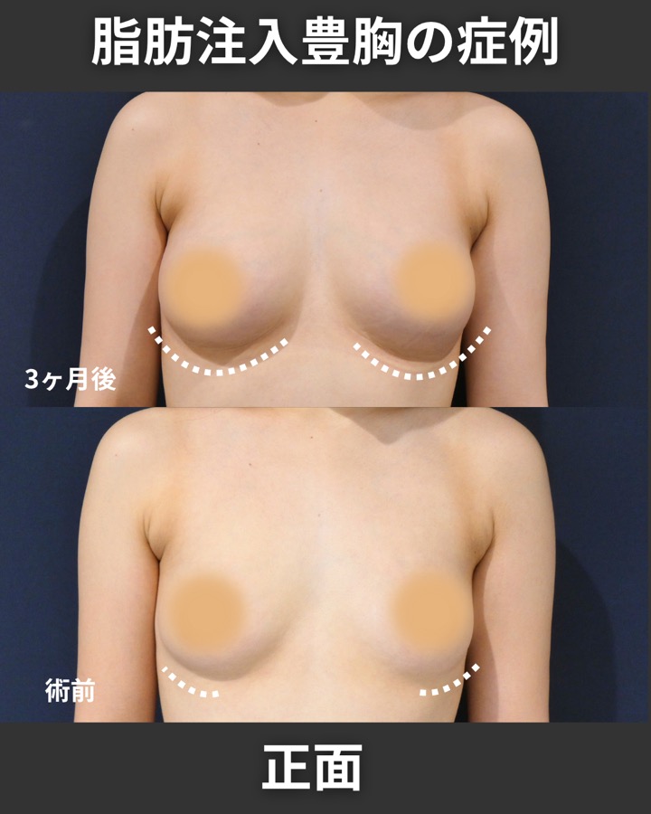 S.T styleクリニックのピュアグラフト豊胸術 症例写真 2/6