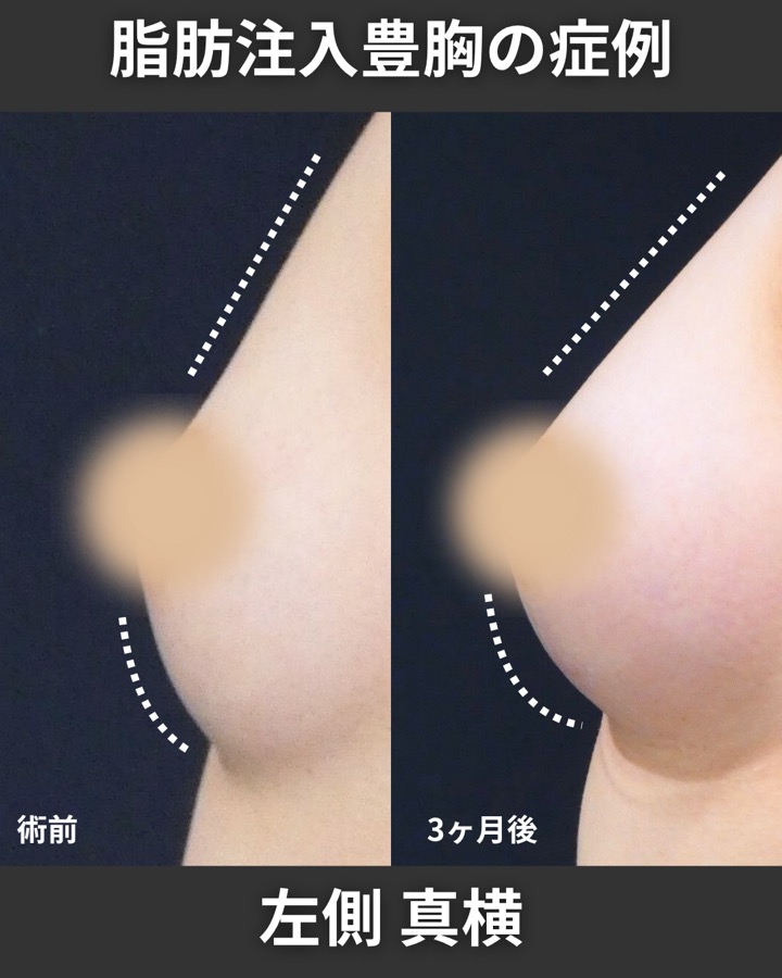 S.T styleクリニックのピュアグラフト豊胸術 症例写真 3/6