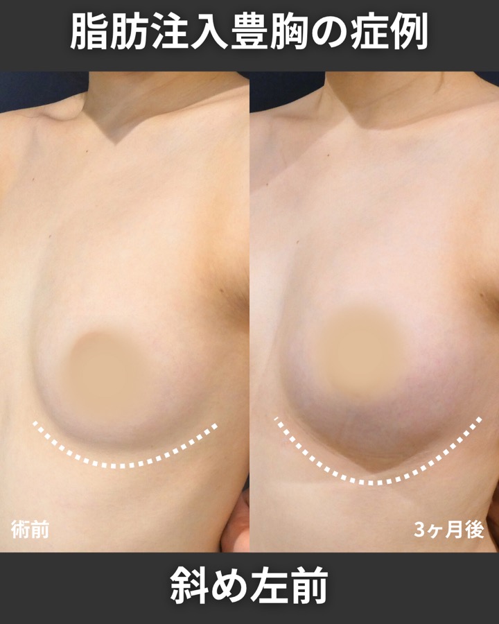 S.T styleクリニックのピュアグラフト豊胸術 症例写真 4/6