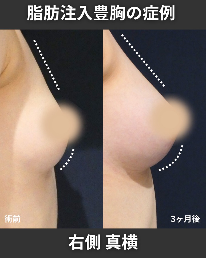 S.T styleクリニックのピュアグラフト豊胸術 症例写真 5/6