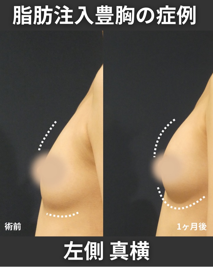 S.T styleクリニックの脂肪注入豊胸 症例写真 2/5