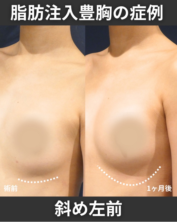 S.T styleクリニックの脂肪注入豊胸 症例写真 3/5