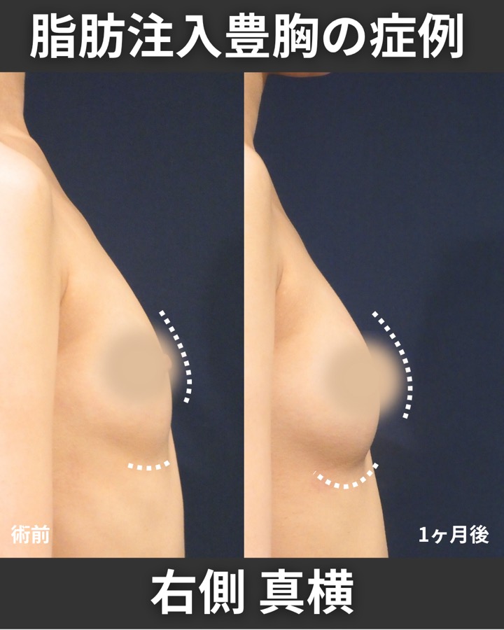 S.T styleクリニックの脂肪注入豊胸 症例写真 4/5