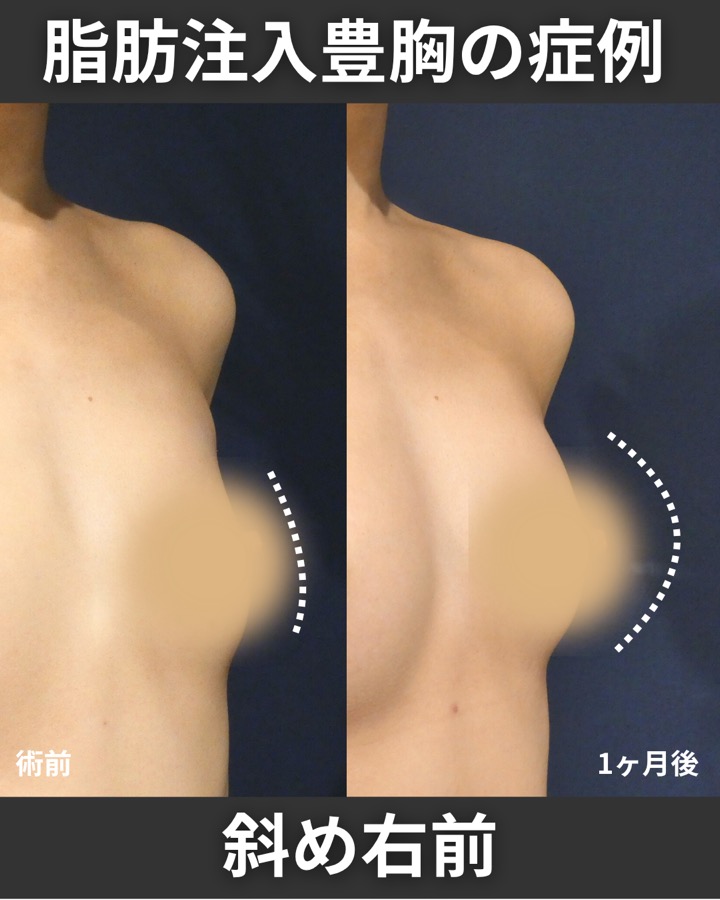 S.T styleクリニックの脂肪注入豊胸 症例写真 5/5